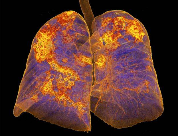 La imagen de los pulmones de una persona infectada muestra zonas con neumonía. 