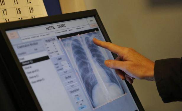 OPS/OMS : Se estima que 50 mil personas desconocen que tienen tuberculosis