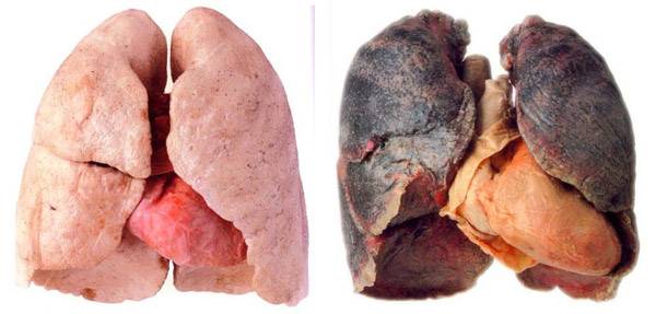 Desarrollan sistema para detección de cáncer de pulmón