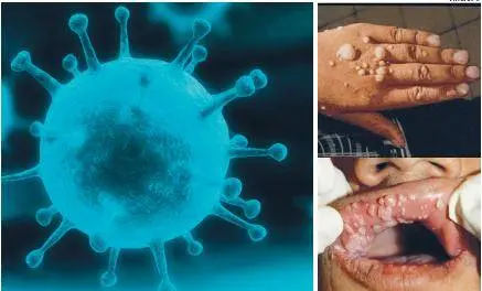 Todo lo que tienes que saber sobre el virus del papiloma humano y sus vacunas
