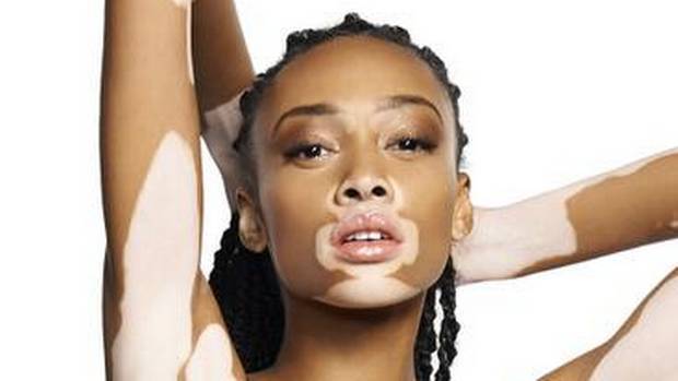 Chantelle Winnie, la modelo con vitiligo que inspira el mundo de la moda