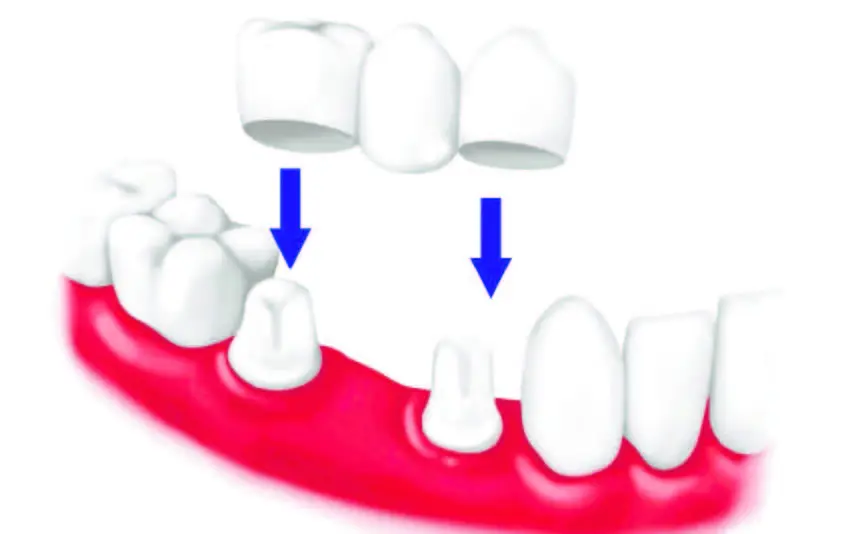 Coronas y puentes en la odontología