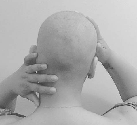 Juliana presenta su cabeza sin cabello como consecuencia de quimioterapia que recibe por el cáncer