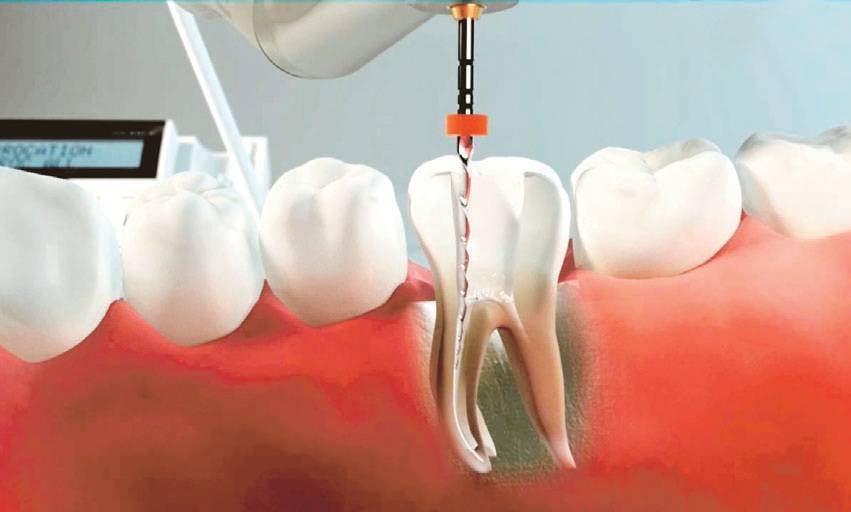 Implantes dentales: ¿Cuáles opciones hay?