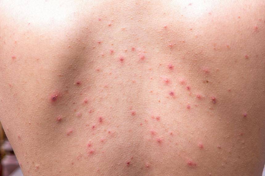Recomendaciones para prevenir la varicela