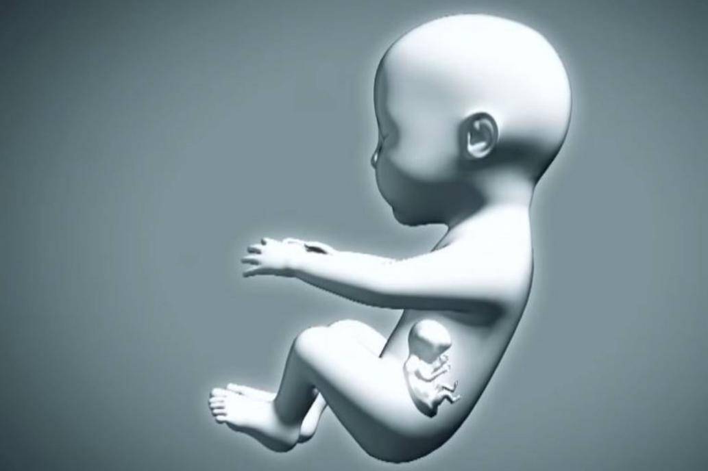 ¡Sorprendente! Bebé nace “embarazada”; entérese cómo y dónde
