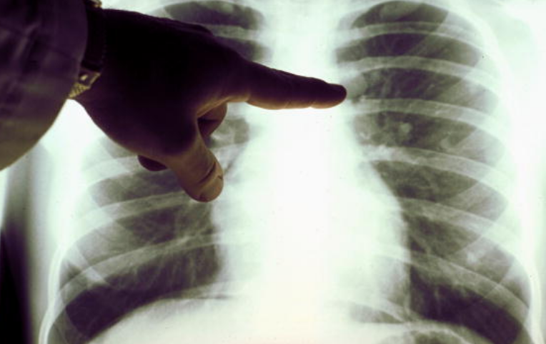 Vea aquí cómo se podrá detectar el cáncer de pulmón antes de que el paciente tenga síntomas