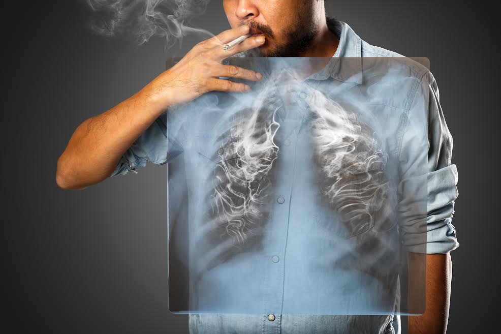 Conozca aquí cuántos fallecen al año en Latinoamérica por cáncer de pulmón