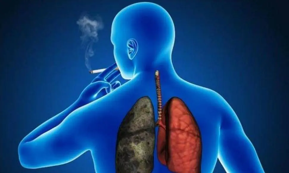 64% de los casos de cáncer de pulmón son causados por el tabaco