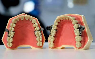 Caída de los dientes: ¿por qué pasa y cómo evitarla?