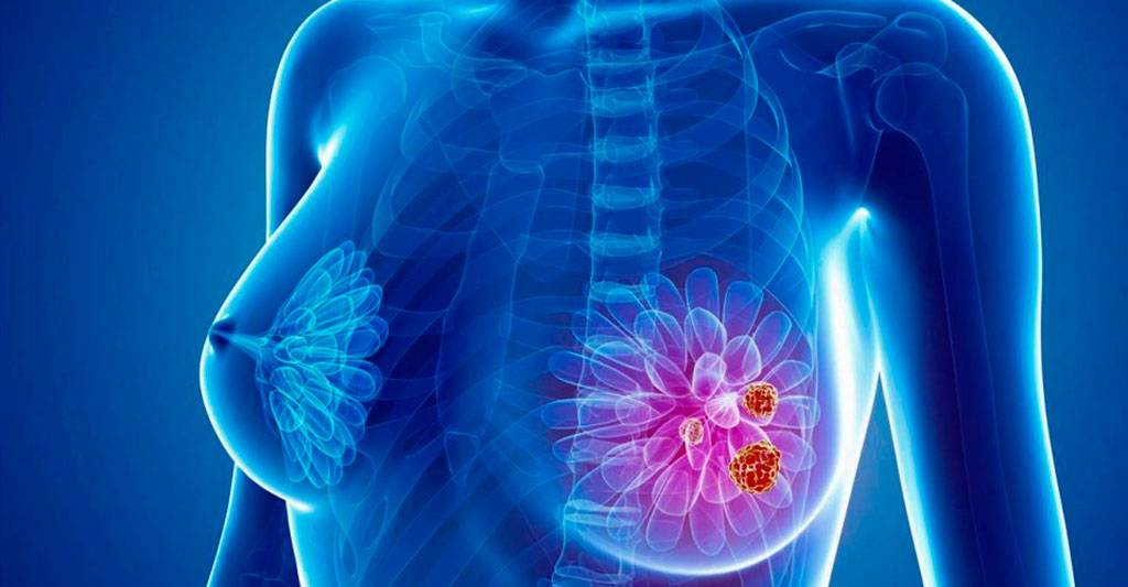 Las células del cáncer de mama crean escudos de colágeno para protegerse