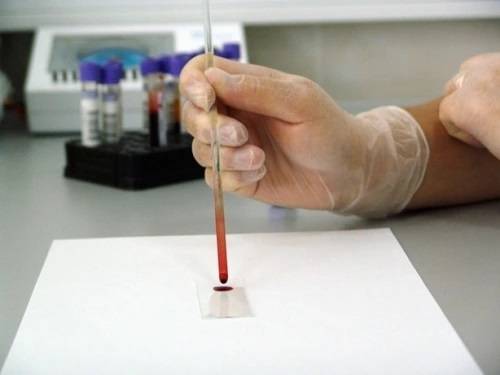 Test permite detección temprana de 50 tipos de cáncer, solo con una gota de sangre