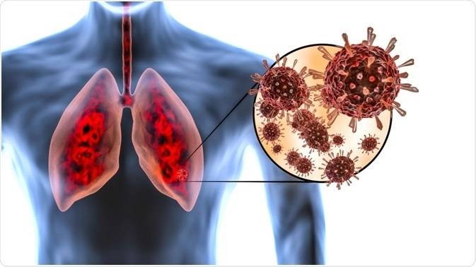 Estudio mejora diagnóstico de daño pulmonar por covid