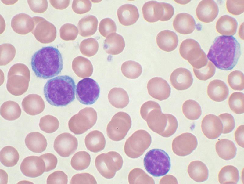 Identifican un gen que causa la leucemia linfocítica crónica sin mutar