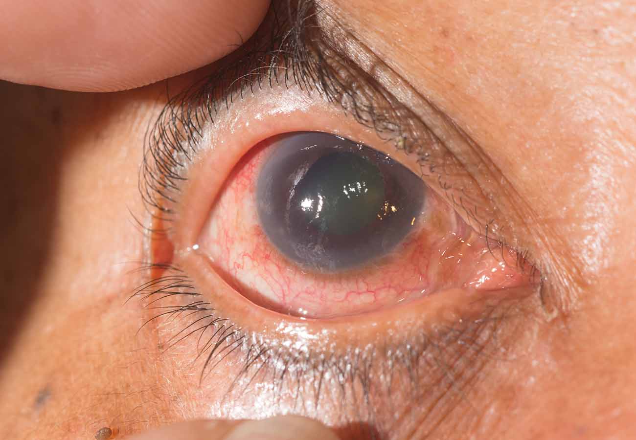 Día Mundial del Glaucoma: ¿Qué es y cómo se previene?
