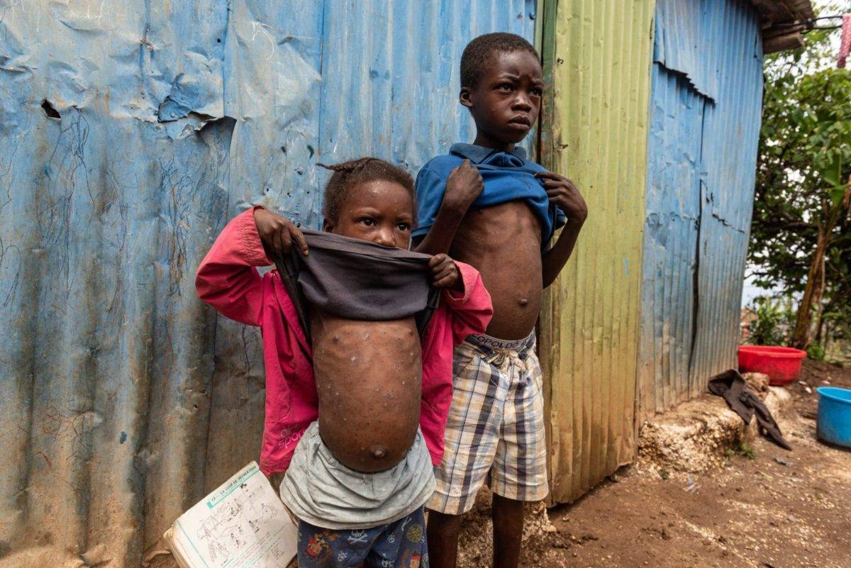 Sarcoptosis: La infección que hace estragos en Haití