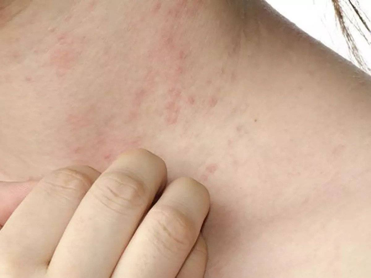 Dermatóloga Pimentel: «Enfermedad contagiosa de la piel no es nueva»