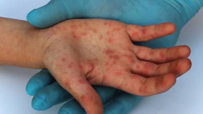 ¿Qué es la viruela símica y dónde se propaga?