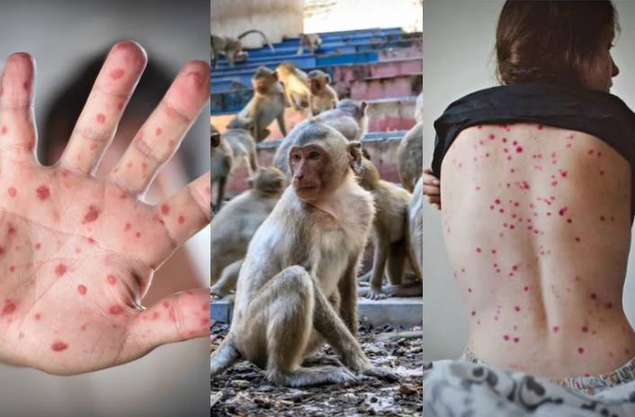 Viruela del mono: Bélgica, primer país en ordenar cuarentena obligatoria a infectados