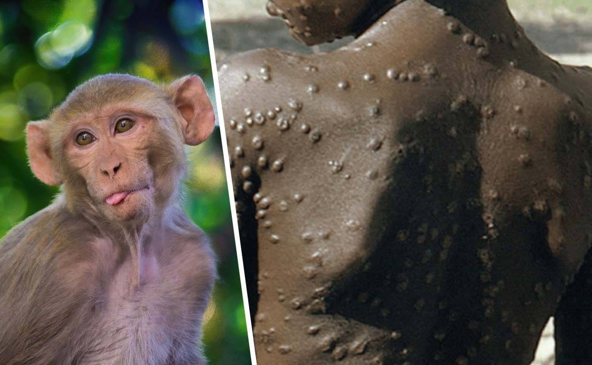 Viruela del mono: Salud Pública emite alerta preventiva