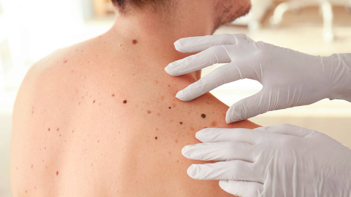 Cáncer de piel: cuáles son los factores de riesgo y cómo prevenirlo
