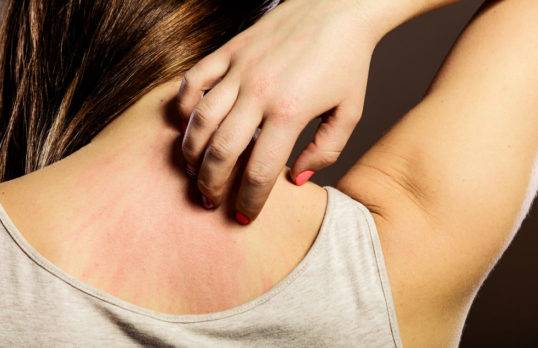 Dermatitis Atópica: Todo lo que debes saber