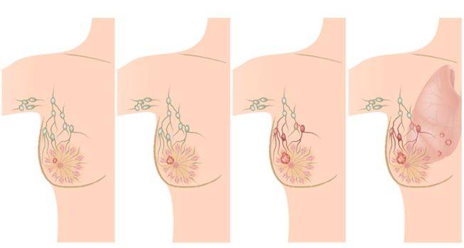 Cómo identificar las diferentes etapas del cáncer de mama
