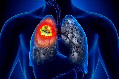 El fumar causa el 80% de las muertes por cáncer de pulmón