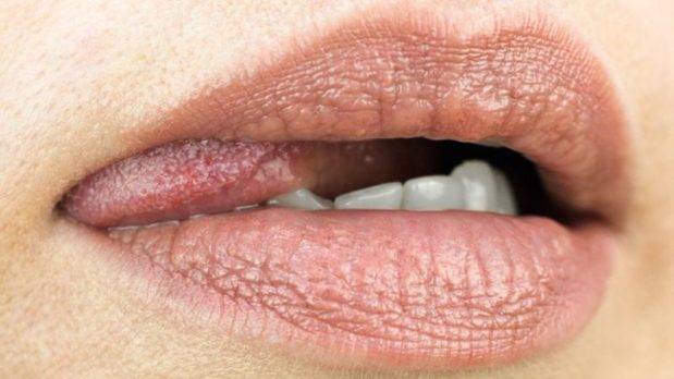 Cáncer de garganta: ¿Por qué el sexo oral puede ser un factor de riesgo?