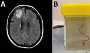 Extraen del cerebro de una australiana una lombriz intestinal viva de 8 centímetros